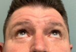Blepharoplasty Before & After Pictures