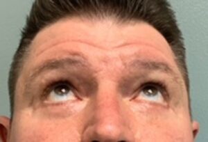 Blepharoplasty Before & After Pictures