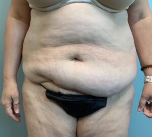 Abdominoplasty Before & After Pictures