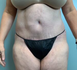 Abdominoplasty Before & After Pictures