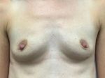 Breast Augmentation Before & After Pictures
