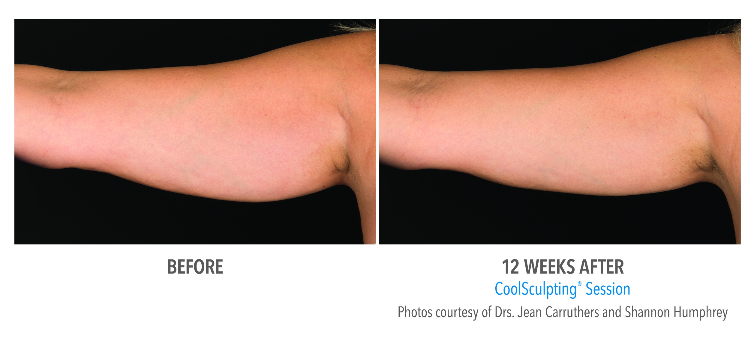 CoolSculpting Before and After