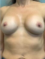 Breast Augmentation Before & After Pictures