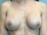 Breast Augmentation Before & After Pictures