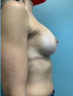 Breast Augmentation Before & After Pictures