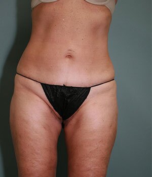 Abdominoplasty or Tummy Tuck Results Detroit