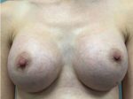 Breast Augmentation Before & After Pictures