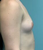 Breast Augmentation Before & After Pictures