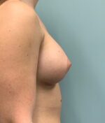 Breast Augmentation Before & After Pictures