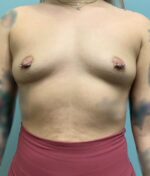 Breast Augmentation Before & After Pictures