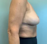 Breast Augmentation with Lift Before & After Pictures